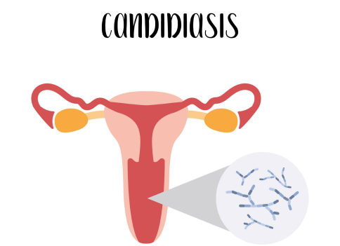 Vaginal Yeast Infections Treatment