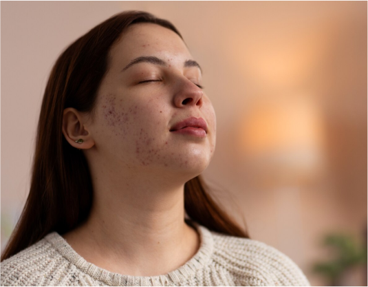 Acne treatment services in Alberta