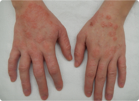 Eczema treatment in Edmonton