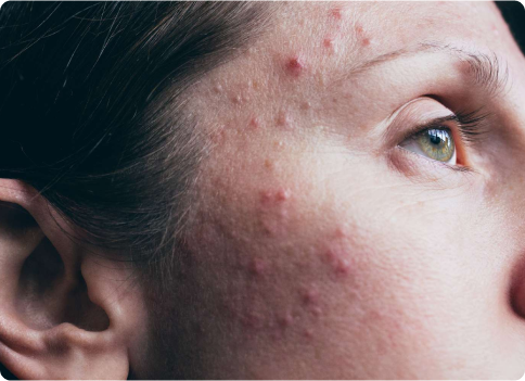 Acne treatment in Edmonton