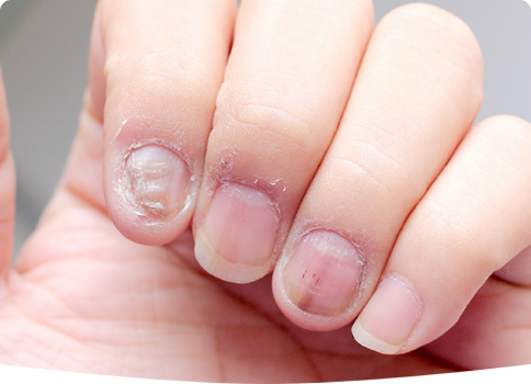 Nail fungus treatment in Alberta