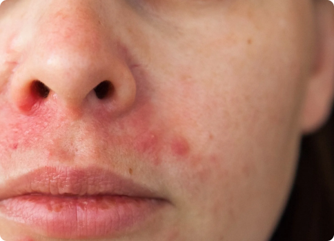 Peri-oral dermatitis treatment in Alberta