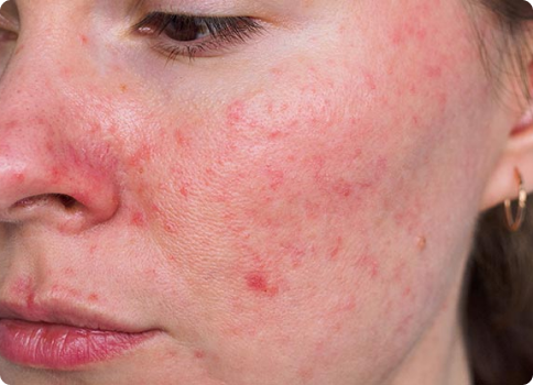 Rosacea treatment in Alberta